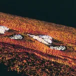 Omniflow® II Vascular Prosthesis