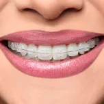 Ceramic Bracket - Iceram-P (Roth and MBT)