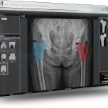 Biomedica X1 A1 Bone Densitometer Solution