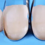 Polydentia Unica Anterior Intro Kit