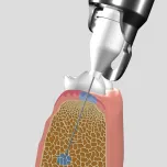 QuickSleeper 5 Intraosseous Anaesthesia Delivery System