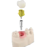 Argen Abutment & Implant Parts