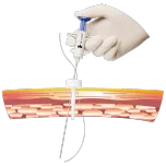 LAGIS Suture Passer (Trocar Site Closure)