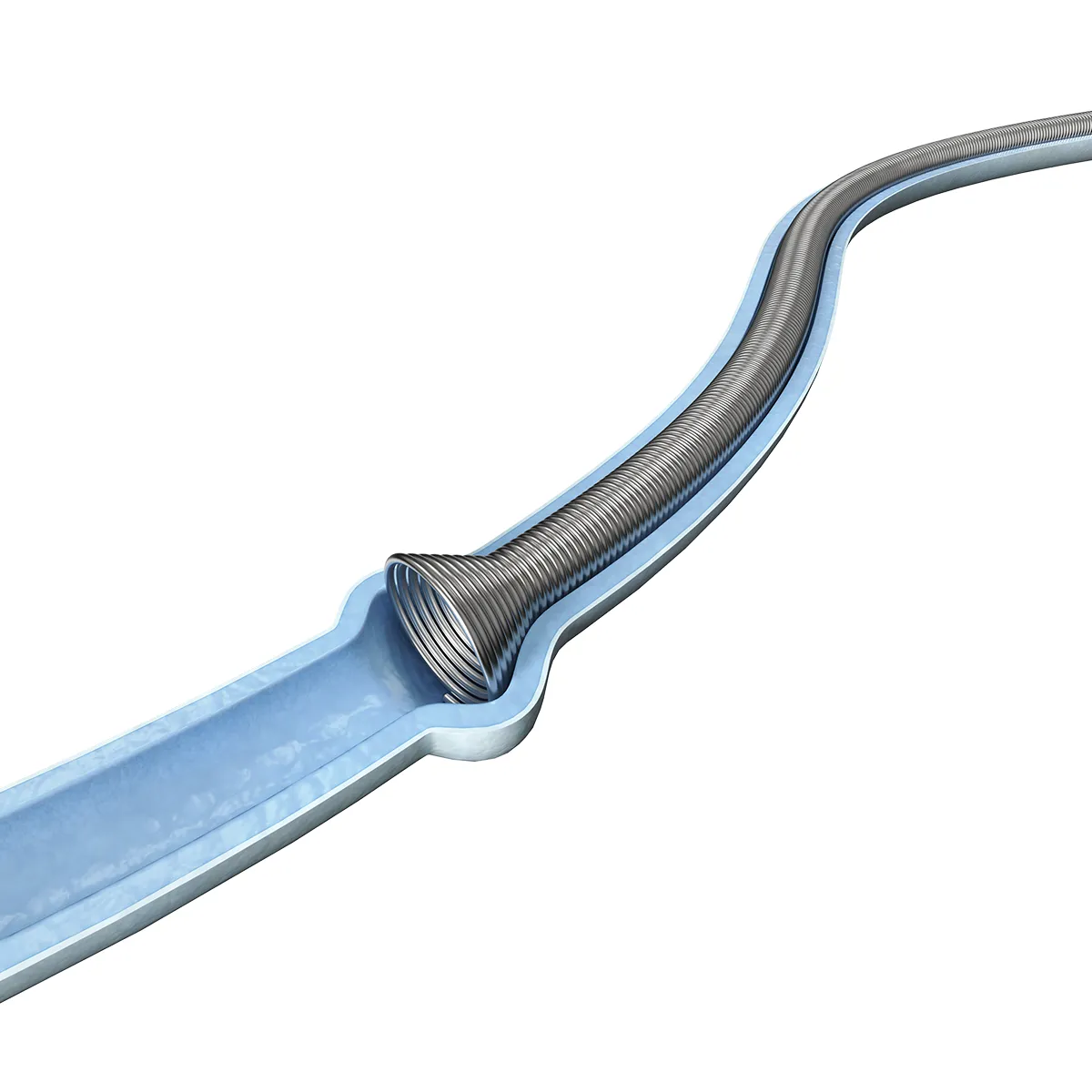Sistema de Stent Ureteral