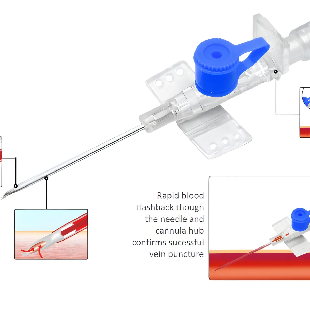 PLUSFLON PRO™ — I.V. CATHETER WITH QUICK FLASHBACK AND ADVANCED NEEDLE TECHNOLOGY