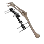 External Fixtator