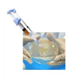 Spray Gun for PRP Gel in Wound Healing