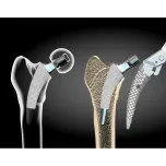 Unas Short Stem System