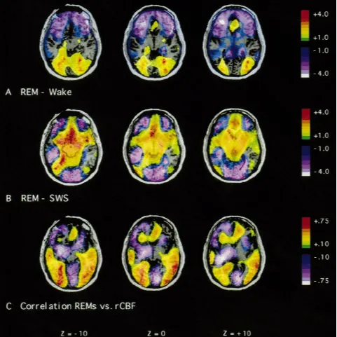 REM Sleep Brain Connectomes and Seizure Susceptibility