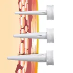 LAGIS Suture Passer (Trocar Site Closure)