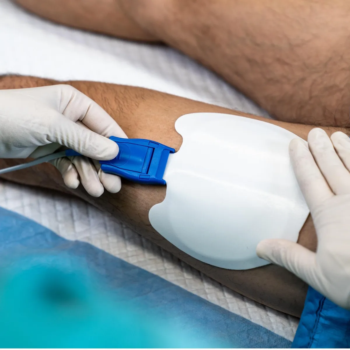 Neutral Electrodes for HF surgery