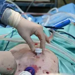 LAGIS Suture Passer (Trocar Site Closure)