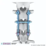Denique , MIS, Pediatric Pedicle Screw Systems