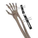 External Fixtator