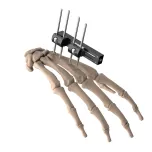 External Fixtator