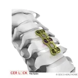CERLOCK-Anterior Cervical Plate System