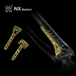 Orthopedic Implant for Trauma