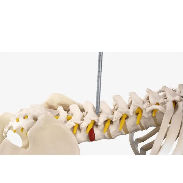 Coluna: Set SpineTIP Interlaminar, Transforaminal e Posterolateral