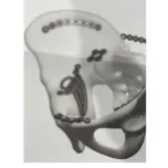 Trauma and Spine implants