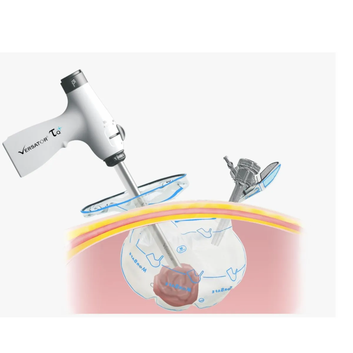 #MorSafe® – Tissue Morcellation Bag