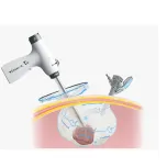 #MorSafe® – Tissue Morcellation Bag