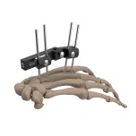 External Fixtator