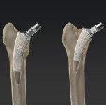 Unas Short Stem System