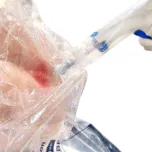 ComfortHeal™ Contained Wound Irrigation System