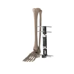 External Fixtator