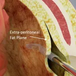 Drain-TG™ - JSR Medical