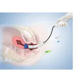 Disposable Balloon Uterine Manipulator
