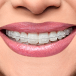 Ceramic Bracket - Iceram-P (Roth and MBT)