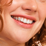 Iceram Clear Distalizer