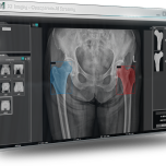 Biomedica X1 A1 Bone Densitometer Solution