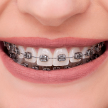 ADVANCED SERIES - MINI LP - METAL BRACKETS - ROTH 0,022"