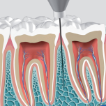 QuickSleeper 5 Intraosseous Anaesthesia Delivery System