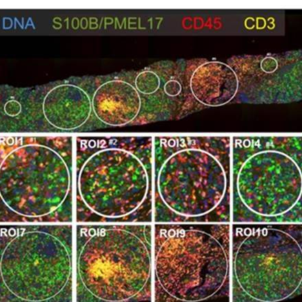 Introduction to GeoMx DSP technology and how it helps to understand the difference in the immune environment between Cutaneous & Uveal Melanoma