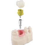 Argen Abutment & Implant Parts