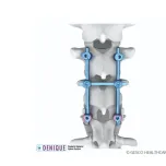 Denique , MIS, Pediatric Pedicle Screw Systems
