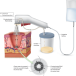 Disposable pulse lavage