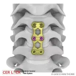 CERLOCK-Anterior Cervical Plate System