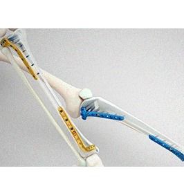 Placas para Pequenos Fragmentos Membros Inferiores