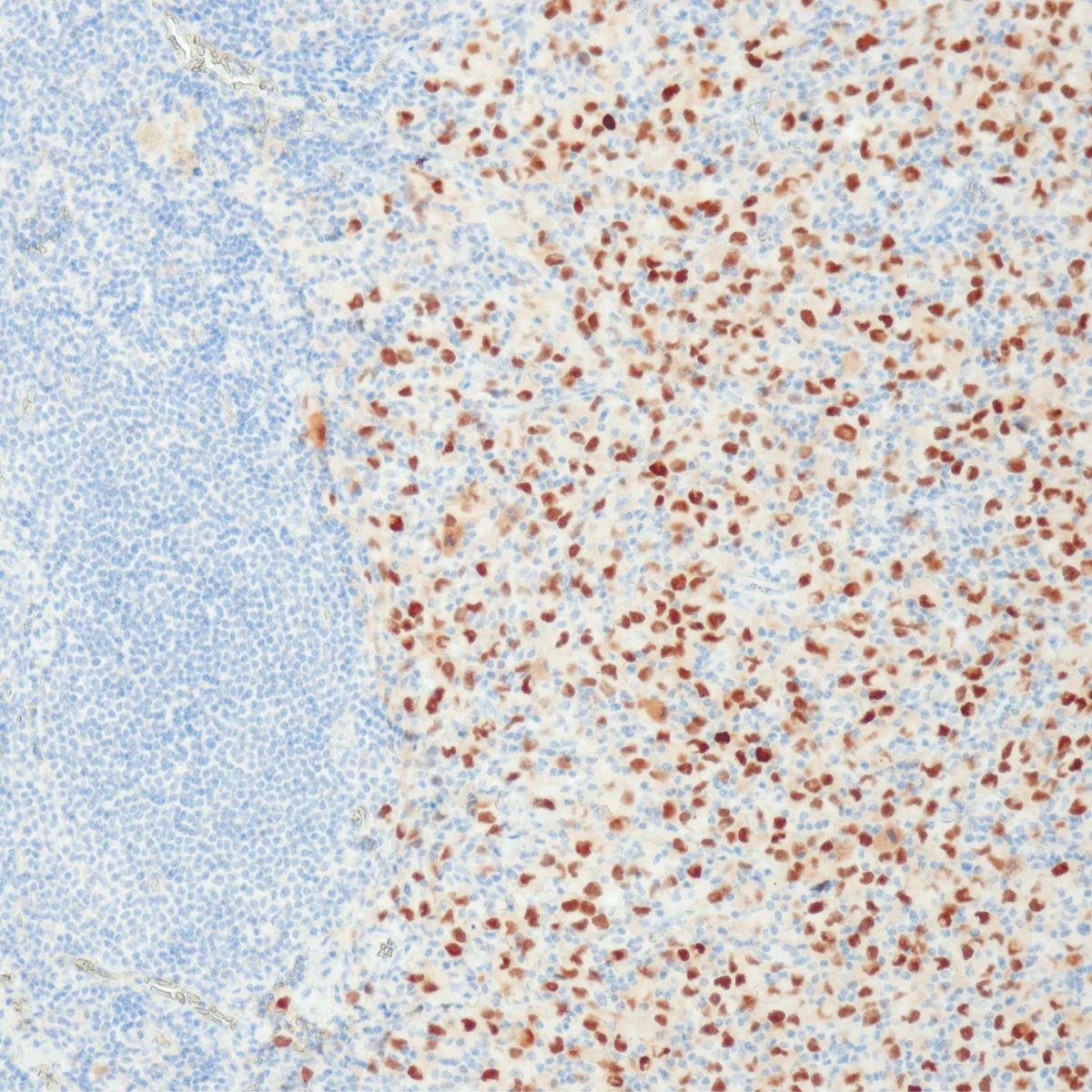 PRAME (QR005) Melanoma Marker IHC