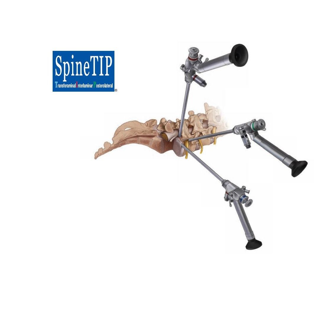 Spine TIP; PELD system