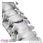 CERLOCK-Anterior Cervical Plate System