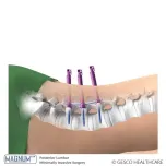 Denique , MIS, Pediatric Pedicle Screw Systems