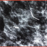 Mamawire Fix D Breast Clip Marker