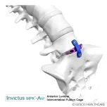 Posterior Lumbar Interbody Fusion procedures (PLIF)( Thoracolumbar interbody cage) & Anterior Lumbar Interbody Fusion Cage