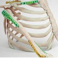 Placas para Pequenos Fragmentos Membros Superiores