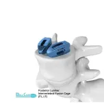 Posterior Lumbar Interbody Fusion procedures (PLIF)( Thoracolumbar interbody cage) & Anterior Lumbar Interbody Fusion Cage